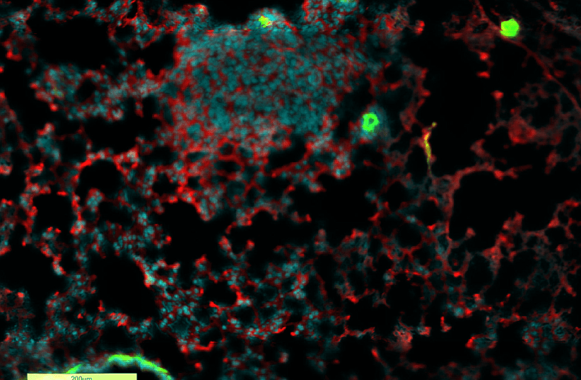 An image of lung with breast cancer metastasis, surrounded by inflammatory complement protein: Cyan: Cell nuclei; Red: Complement protein; Green: blood vessels; (photo credit: LEA MONTERAN)