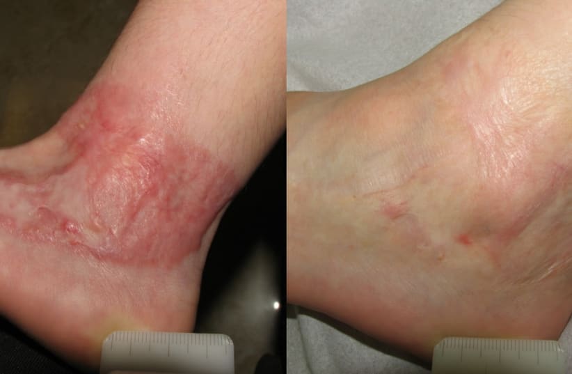 Before and after treatment for a surgical scar after a burn by Pulse-Dye Laser followed by Fractionated CO2 in the same session (photo credit: Dr. David Friedman )