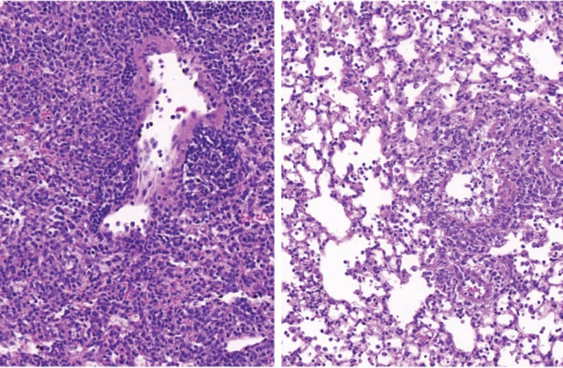  Lung tissue of a diabetic mouse (right) contains fewer immune cells (small purple dots) than that of a non-diabetic animal (left). (photo credit: WEIZMANN INSTITUTE OF SCIENCE)