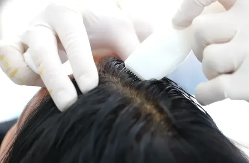  Injection of synthetic hair in the scalp (photo credit: Hairstatics)