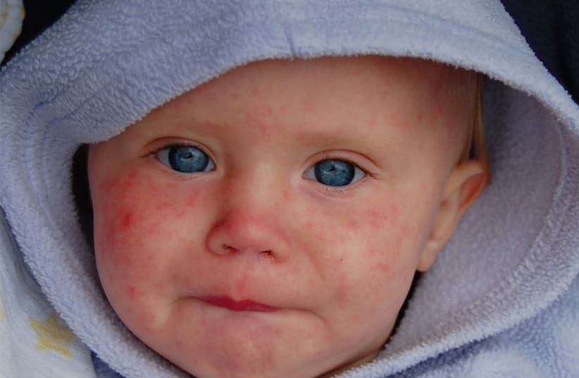  Un NIÑO con sarampión. (photo credit: ILLUSTRATIVE; DAVE HAYGARTH/FLICKR)