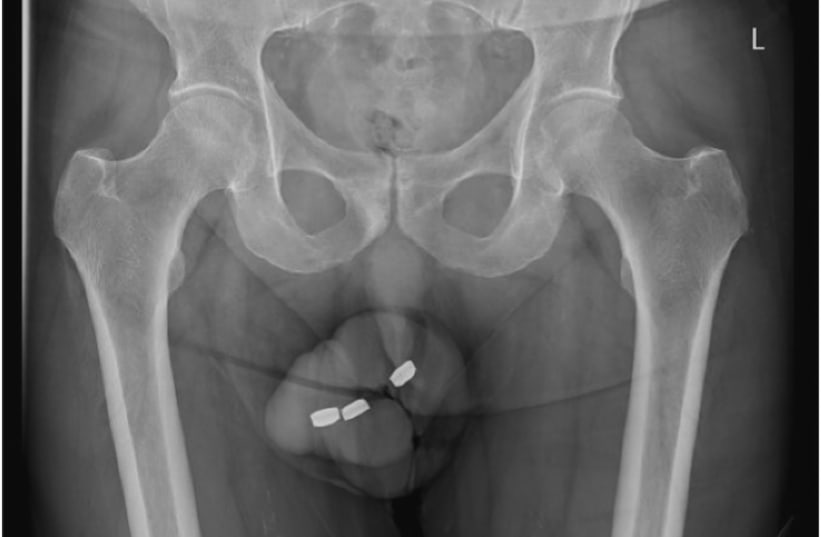 Plain pelvic radiographs demonstrating three button batteries within the penile urethra. (photo credit: Creative Commons/Science Direct)