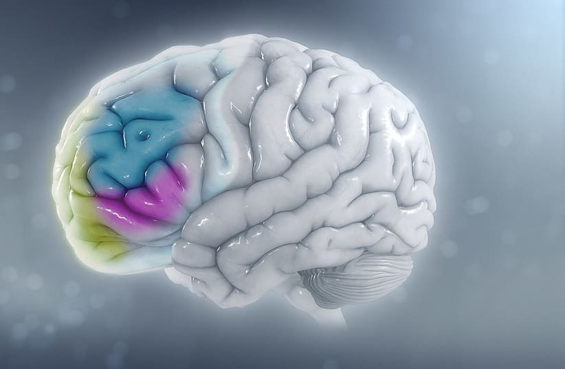  Cerebro de un niño con TDAH con volumen general reducido y una reducción proporcional en la corteza prefrontal izquierda. (photo credit: Wikimedia Commons)