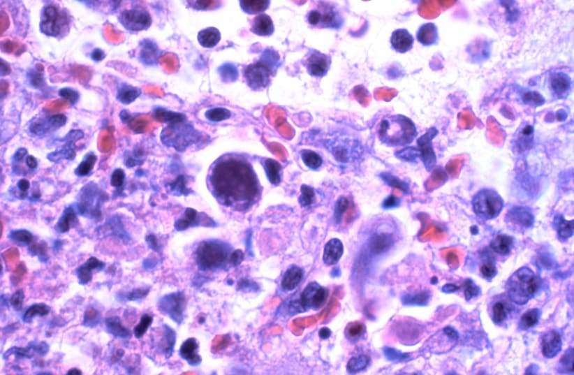 Cytomegalovirus infection. (photo credit: YALE ROSEN/CC 2.0/https://creativecommons.org/licenses/by-sa/2.0/deed.en)