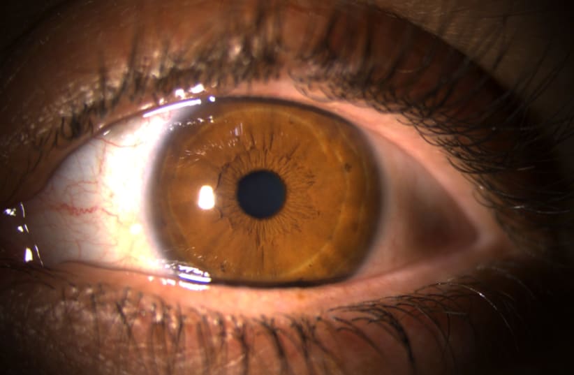 The first shows the eye after treatment without inflammation or edema. (photo credit: SHAARE ZEDEK MEDICAL CENTER)