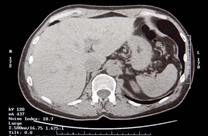  CT abdomen (photo credit: SHUTTERSTOCK)