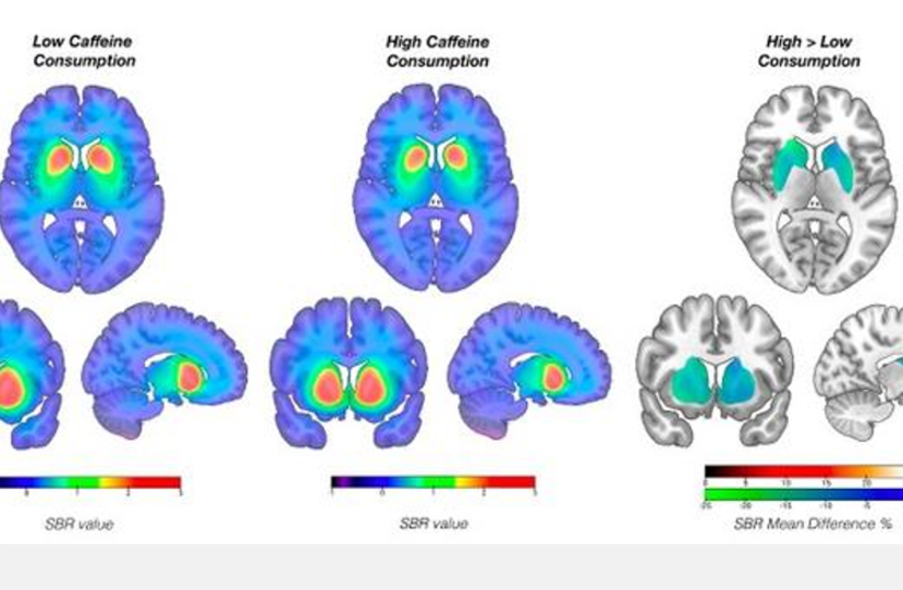  The effects of high and low consumption of caffeine on the brain’s dopamine transporter binding in patients diagnosed with Parkinson’s disease. (photo credit: Clinical Neurosciences / University of Turku)