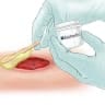 MediWound’s EscharEx treatment, which is being tested in a global study for chronic wounds that fail to heal.