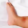 Mosquito bite