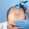 Hair transplants in Dubai offer natural, minimally invasive results at top clinics, boosting confidence.