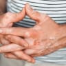 The scientific progress of recent years is changing the way we diagnose, treat and understand vitiligo