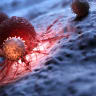 Illustration of a pancreatic tumor surrounded by immune cells