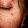 A sign of cumulative damage the skin absorbs over the years. Pigmentation spots.