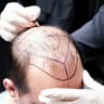 From Istanbul Care to established names, explore what to consider when comparing hair transplant clinics in Turkey.