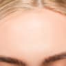 Forehead reduction surgery can reshape the hairline and facial proportions.
