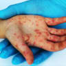 Measles infection (illustrative)