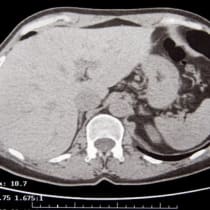  TAC abdomen