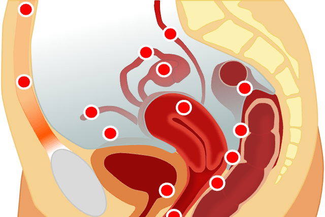 Localisation of endometriosis, illustrative.  (photo credit: Wikimedia Commons)