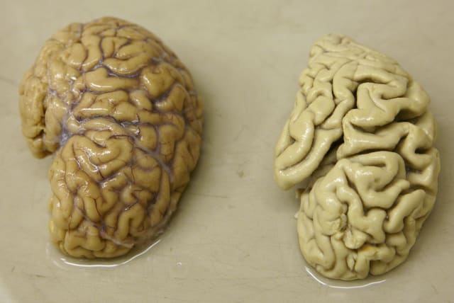  One hemisphere of a healthy brain (L) is pictured next to one hemisphere of a brain of a person suffering from Alzheimer disease, at the Morphological unit of psychopathology in the Neuropsychiatry division of the Belle Idee University Hospital in Chene-Bourg near Geneva March 14, 2011. (photo credit: DENIS BALIBOUSE/REUTERS)
