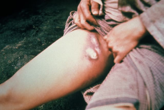   This plague patient is displaying a swollen, ruptured inguinal lymph node, or buboe. (photo credit: CENTERS FOR DISEASE CONTROL AND PREVENTION VIA WIKIMEDIA COMMONS)