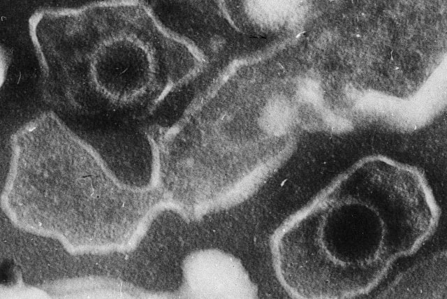  This electron microscopic image of two Epstein Barr Virus virions (viral particles) shows round capsids—protein-encased genetic material—loosely surrounded by the membrane envelope. (photo credit: LIZA GROSS/WIKIMEDIA COMMONS)