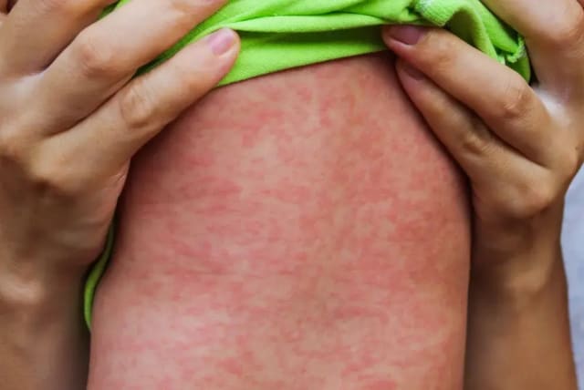 Highly contagious disease. Child with measles. (photo credit: SHUTTERSTOCK)
