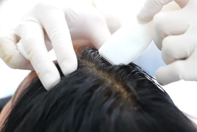  Injection of synthetic hair in the scalp (photo credit: Hairstatics)