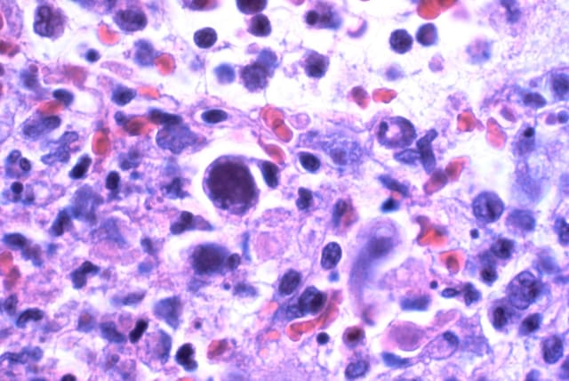 Cytomegalovirus infection. (photo credit: YALE ROSEN/CC 2.0/https://creativecommons.org/licenses/by-sa/2.0/deed.en)