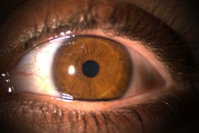 The first shows the eye after treatment without inflammation or edema. (photo credit: SHAARE ZEDEK MEDICAL CENTER)