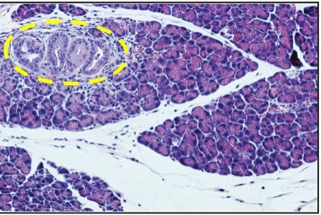  Pancreas sections from control and P. gingivalis-infected mice. Control mouse showing a small pre-cancerous lesion (photo credit: Nussbaum Lab, Hebrew University)